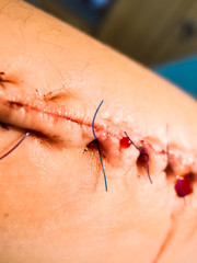 Bleeding Suture with Blood Drainage