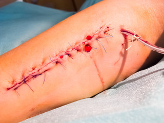 Bleeding Suture with Blood Drainage