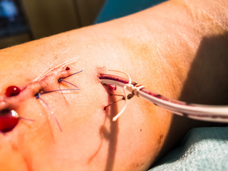 Bleeding Suture with Blood Drainage