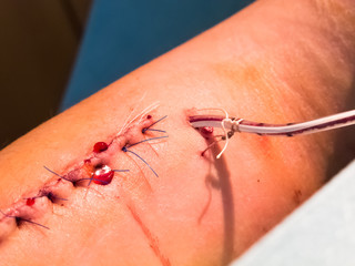 Bleeding Suture with Blood Drainage