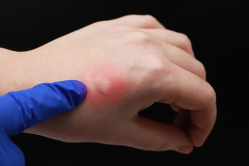 Redness and itching on the arm. The doctor examines the hand on which the bite of an insect, a mosquito