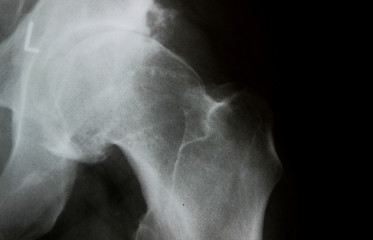 X-Ray image of hip bone with degeneration of the joint (Coxarthrosis)