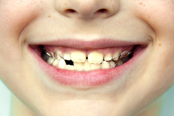 A child smiles with an anatomical orthodontic plate made of flesh-colored pink acrylic and metal attached to the upper jaw of the milk teeth to maintain proper bite. Front view. Close up. © Taste it