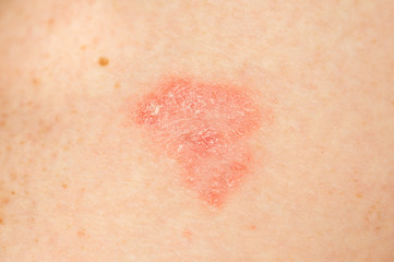 Allergic rashes on the skin closeup. Psoriasis, atopic dermatitis, eczema. Skin manifestations....