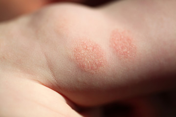 Atopic dermatitis in a child