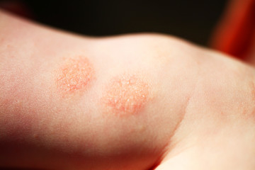 Atopic dermatitis in a child