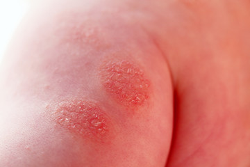 Fototapeta premium Atopic dermatitis in a child