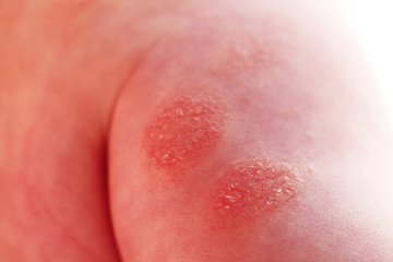 Atopic dermatitis in a child