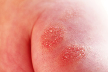 Fototapeta premium Atopic dermatitis in a child