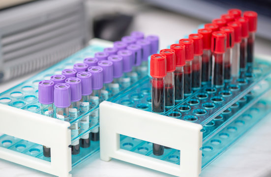 Tubes of blood sample for testing