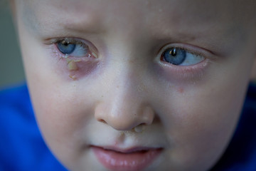 Child with purulent conjunctivitis, contagious eye infection. Symptoms and treatment concept. Close up.