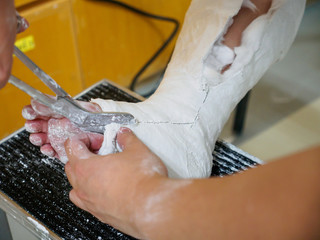 Closeup detail of a physican using cast scissors to cut a orthopedic plaster cast around a healed...
