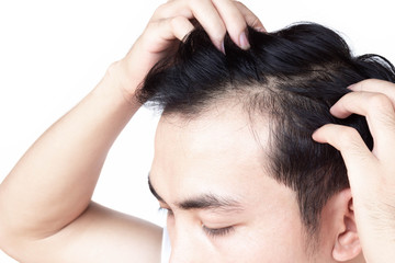 Fototapeta premium Young man serious hair loss problem for health care medical and shampoo product concept