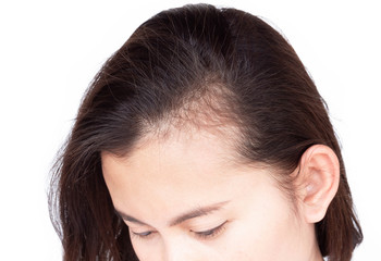 Fototapeta premium Woman serious hair loss problem for health care shampoo and beauty product concept, selective focus