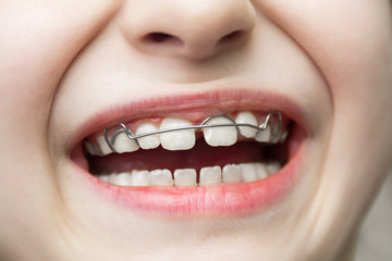 A girl with a removable orthodontic appliance. A child with a bracket on the teeth. Concept of pediatric dentistry, correcting the bite. Closeup, selective focus