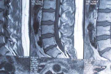 Magnetic resonance tomography (MRT) of the lumbar spine. Hernia of the lumbar spine. Schmorl...