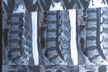 Magnetic resonance tomography (MRT) of the lumbar spine. Hernia of the lumbar spine. Schmorl...