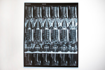 Magnetic resonance tomography (MRT) of the lumbar spine. Hernia of the lumbar spine. Schmorl...