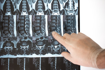 Doctor hand shows something on MRI results (magnetic resonance therapy)