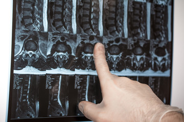 Doctor hand shows something on MRI results (magnetic resonance therapy)