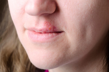 Closeup of woman`s lips and herpes.Fever blisters on the lips