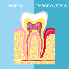healthy tooth and tooth with periodontal disease. anatomy of human organs. Tooth periodontal disease.  image tooth Periodontitis disease.