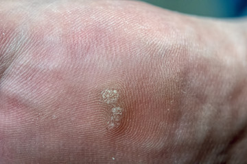 Closeup of foot with an infected wart (Verruca)