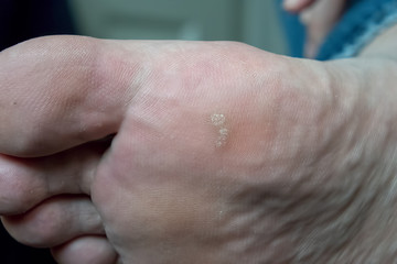 Closeup of foot with an infected wart (Verruca) - obrazy, fototapety, plakaty