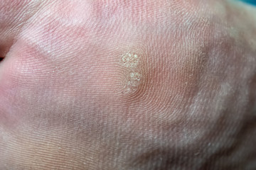 Fototapeta premium Closeup of foot with an infected wart (Verruca)