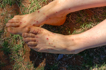 Feet and legs of a woman with midge bites, bitten by hundreds of midges in Western Australia - obrazy, fototapety, plakaty