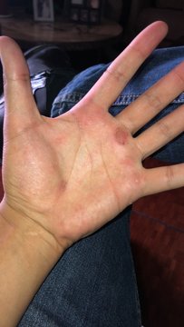 Ampollas en la mano 