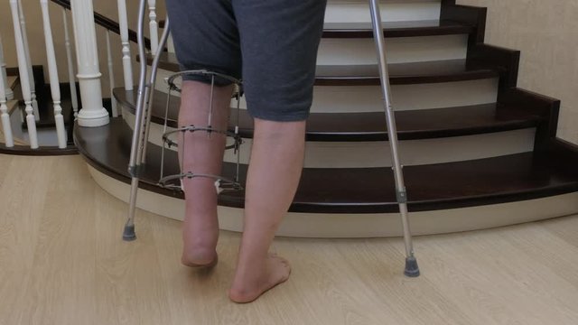 Climbing the stairs on crutches with a broken leg in the Ilizarov's external fixator