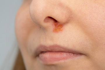 A close up a Caucasian lady showing an infected scab beneath the nasal cavity, similar to the herpes virus.