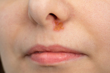 A closeup view of a Caucasian woman with a yellow and crusty scab beneath her nose, similar to the herpes virus.