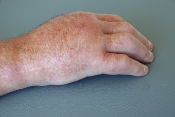 Angeschwolle Hand bei Arthrose
