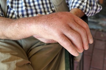 Angeschwolle Hand bei Arthrose