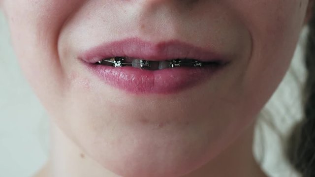 Mund eines M&auml;dchen mit Zahnspange, Nahaufnahme
