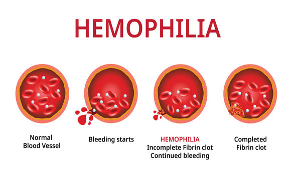 Hemophilia. damaged blood vessel, Haemophilia (Coagulation disorder) - Vector