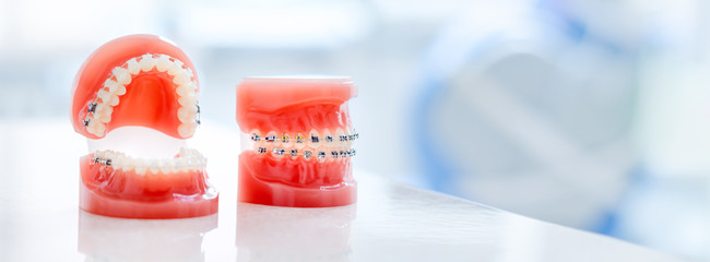 Orthodontic model and dentist tool - demonstration teeth model of varities of orthodontic bracket...