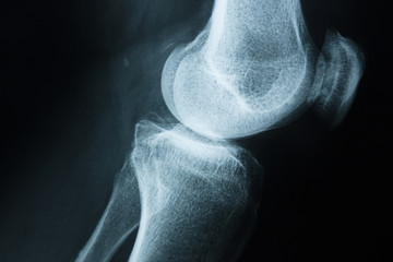Detail of the x-ray of the bones of the human knee