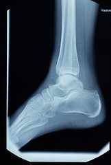 Detail of the x-ray of the bones of the human right foot