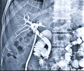 A T-tube cholangiogram is a fluoroscopic procedure in which contrast medium is injected through a T-tube into the patient's biliary tree.