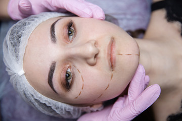 Preparation for plastic surgery. Young model in the clinic with perforation lines on her face