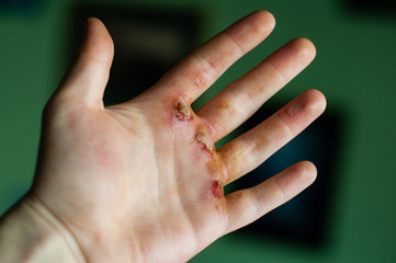 Deep blisters on hand, concept image, working too hard