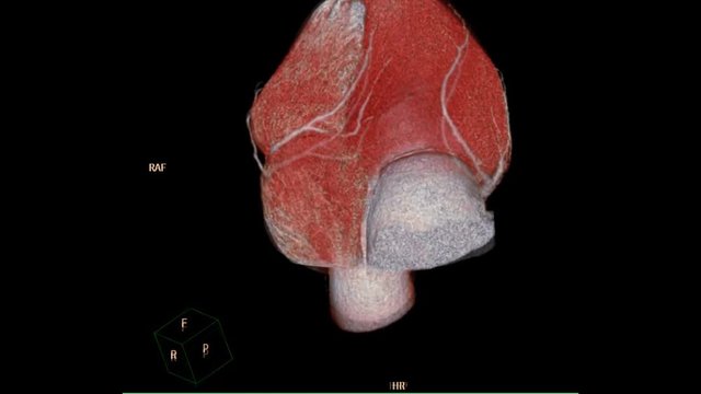 CTA Coronary Artery 3D rendering image heart and vessel Coronary Artery turn around on the screen.