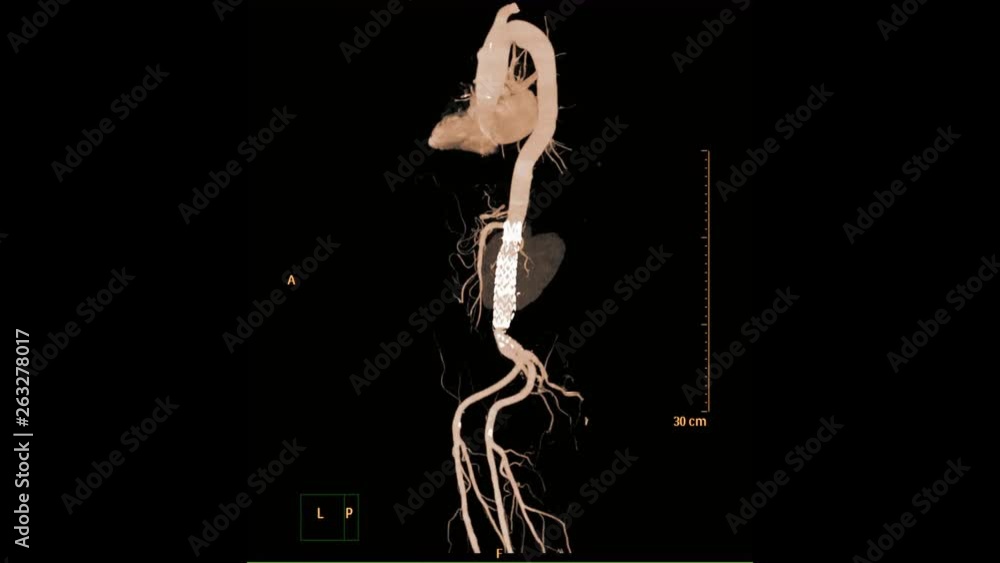 Aufkleber cta abdominal aorta 3d rendering image turn around on the screen showing abdominal aorta with stent 