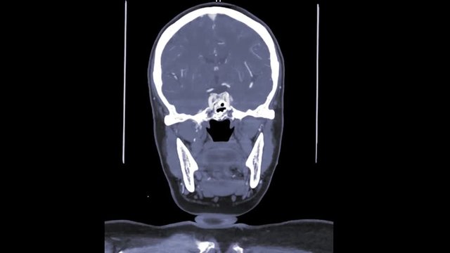 CT SCAN of the brain  or CT brain with contrast media coronal view front to back.