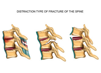 distraction type of fracture of the spine