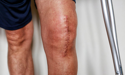 Man on crutches after knee replacement surgery, stitches close up. Painful scar after knee surgery - obrazy, fototapety, plakaty