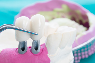 Fototapeta na wymiar Close up Implan model tooth support fix bridge implan and crown.